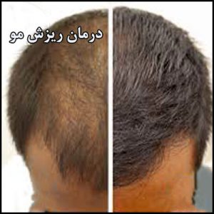 درمان طبیعی ریزش مو در خانه